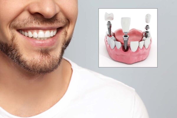 Where to got for Dental Implants in Los Angeles